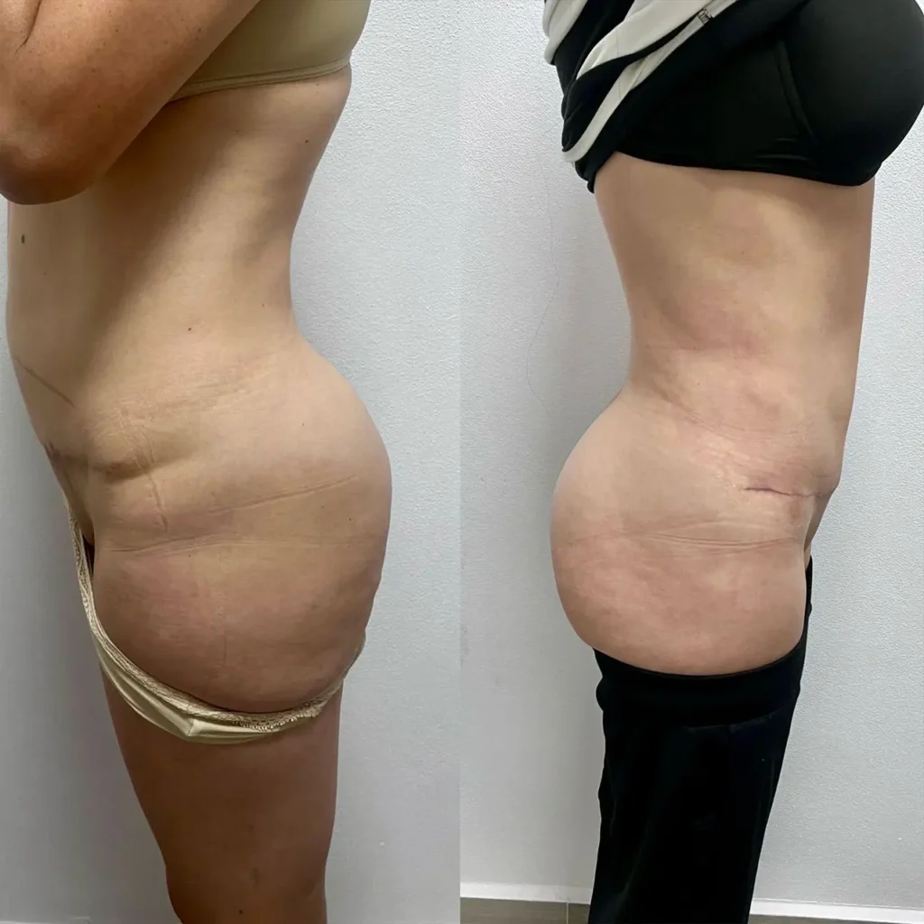 aumento gluteos