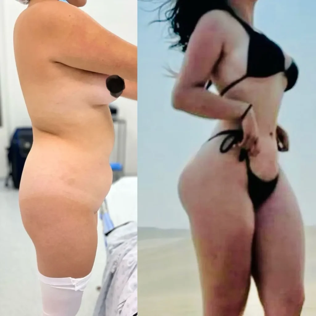 lipoescultura