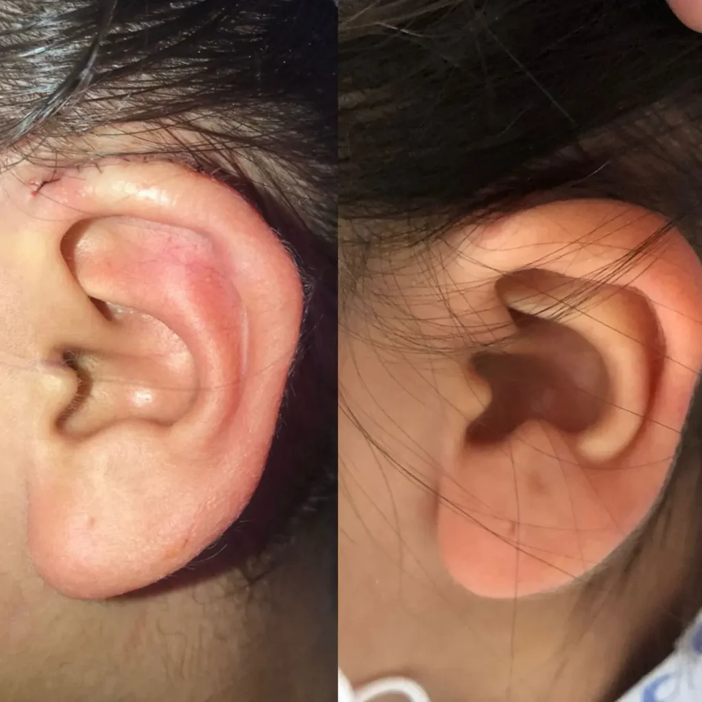 otoplastía