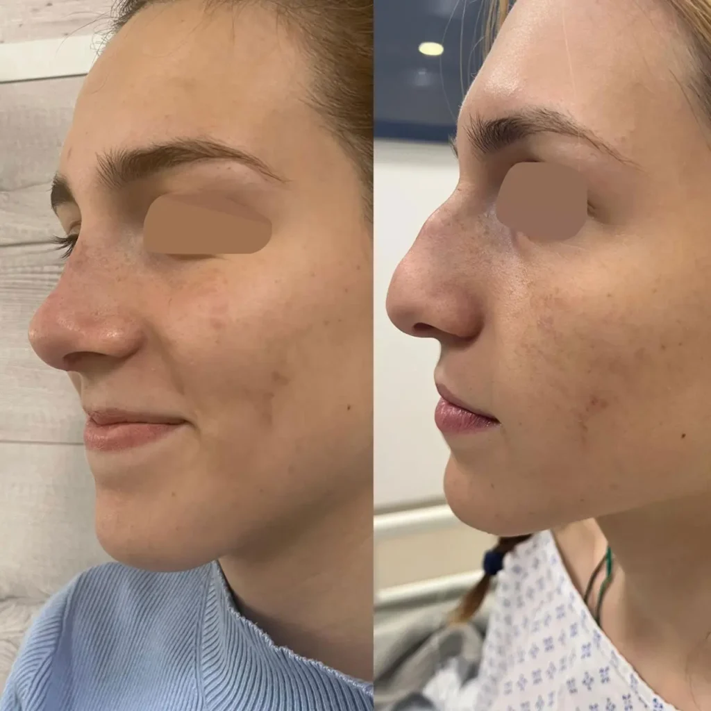 rinoplastia